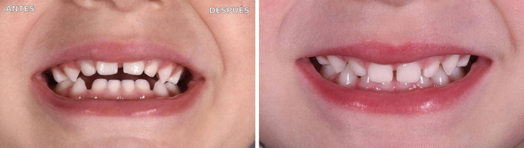 Bioactivador DECIDOUS Modelo DCR — caso clínico antes y después