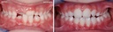 Bioactivador Modelo F — caso clínico antes y después