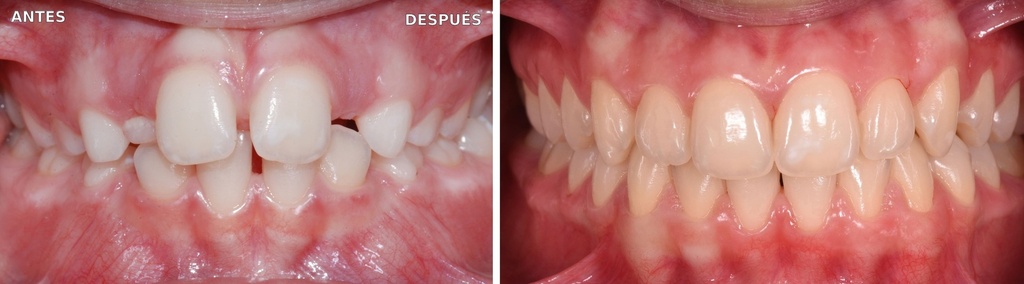 Bioactivador Modelo SC — caso clínico antes y después