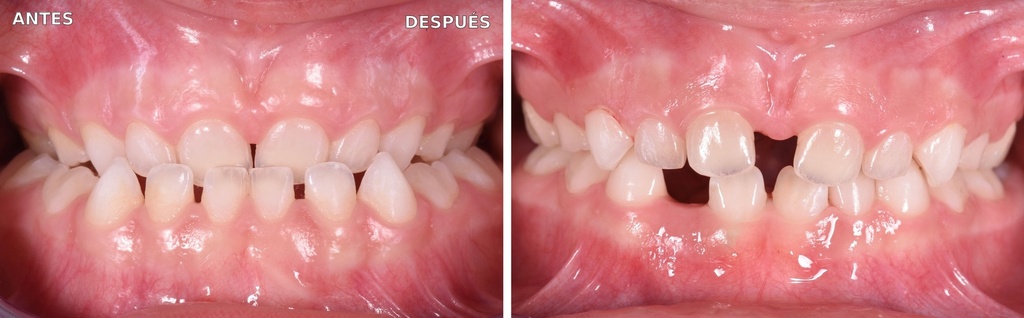 Bioactivador Modelo TC — caso clínico antes y después