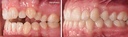 Bioactivador DTM Modelo ØS — caso clínico antes y después