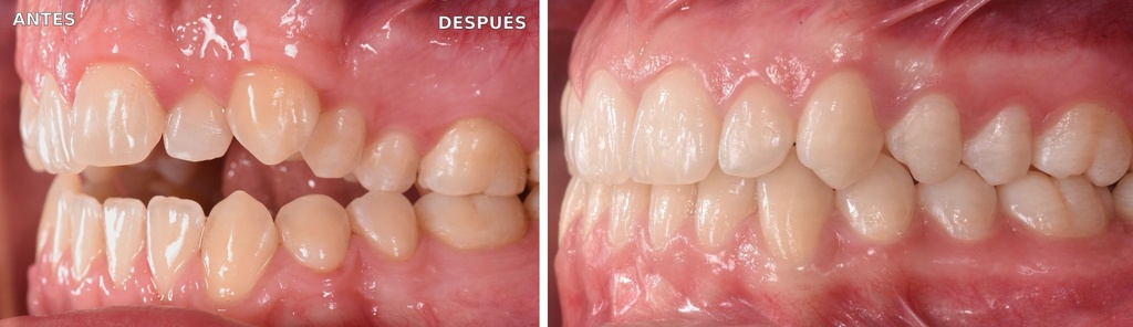Bioactivador DTM Modelo C — caso clínico antes y después