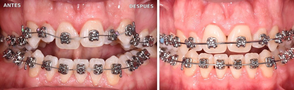 Bioactivador Integral PLUS — caso clínico antes y después