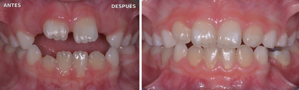 Bioactivador OSAS — caso clínico antes y después