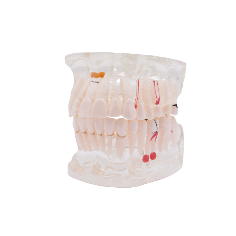 Modelo Transparente con Implante