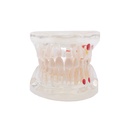 Modelo transparente de caries