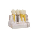 Modelo demostración de implantes